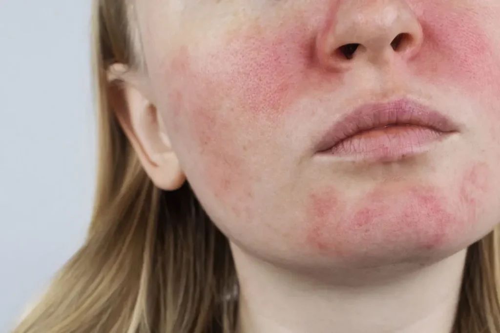 A lady having redness on her face. 