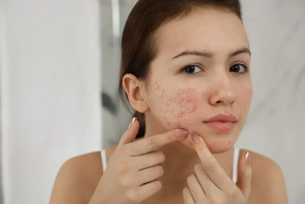 A lady having acne on her face. 