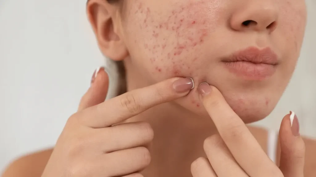 girl face with adult acne breakouts