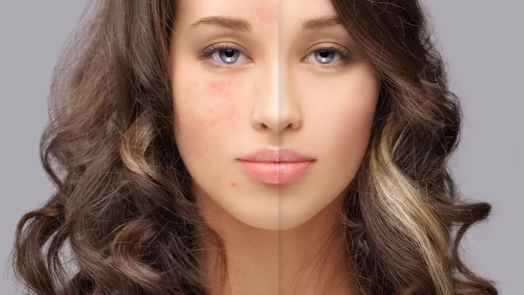 Young girl before and after of acne scars